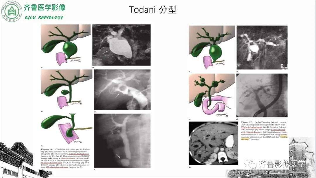影像PPT - 【PPT】先天性胆管扩张症-11