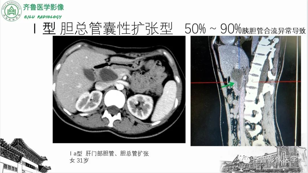 影像PPT - 【PPT】先天性胆管扩张症-12
