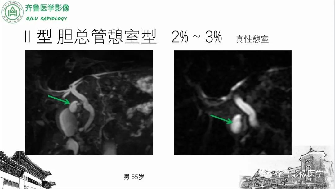 影像PPT - 【PPT】先天性胆管扩张症-14