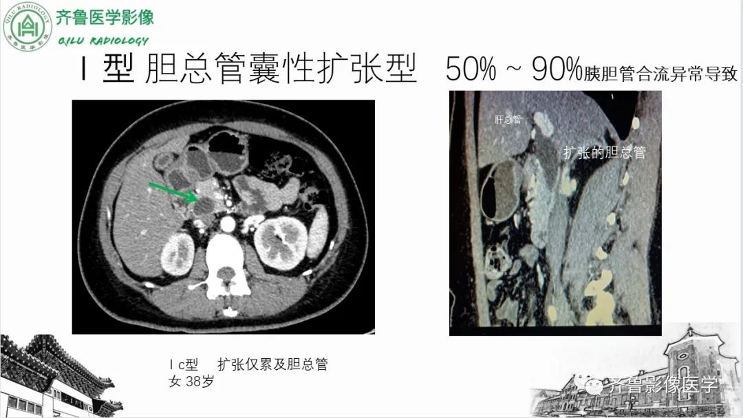 影像PPT - 【PPT】先天性胆管扩张症-13