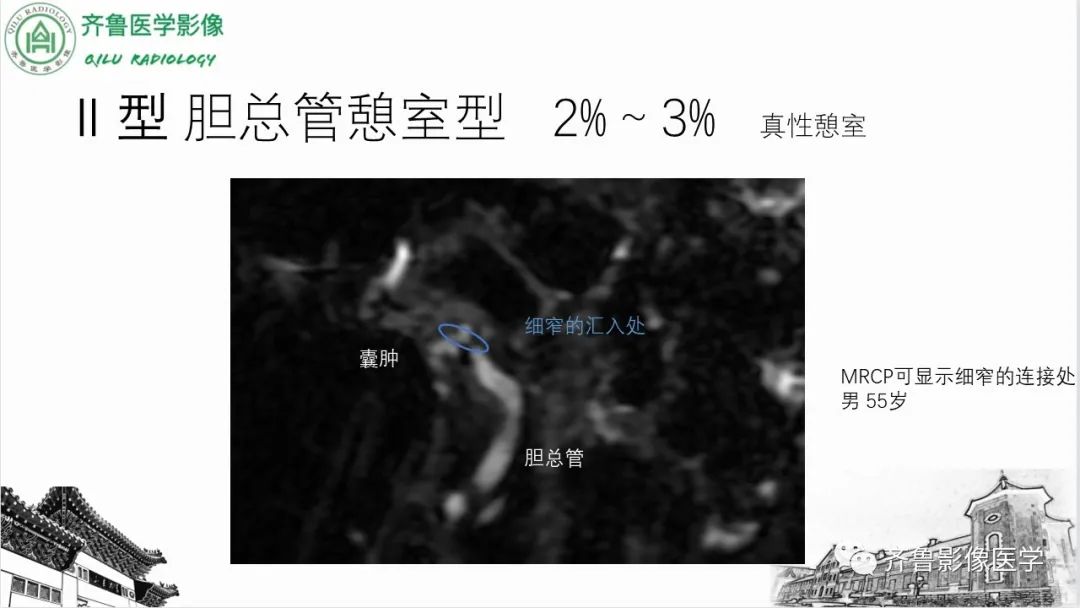 影像PPT - 【PPT】先天性胆管扩张症-15