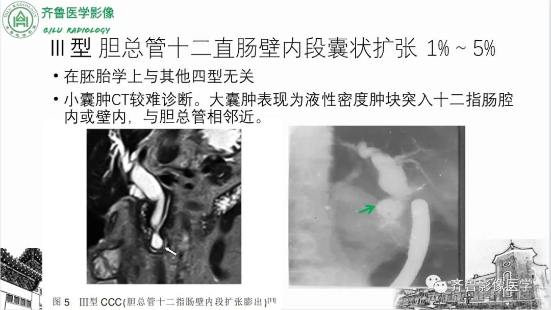 影像PPT - 【PPT】先天性胆管扩张症-16