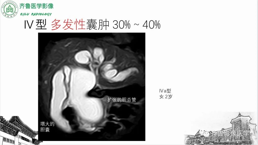 影像PPT - 【PPT】先天性胆管扩张症-17
