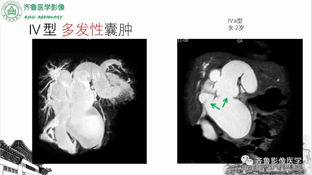 影像PPT - 【PPT】先天性胆管扩张症-18
