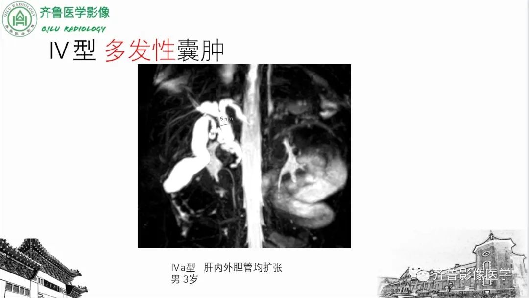 影像PPT - 【PPT】先天性胆管扩张症-19