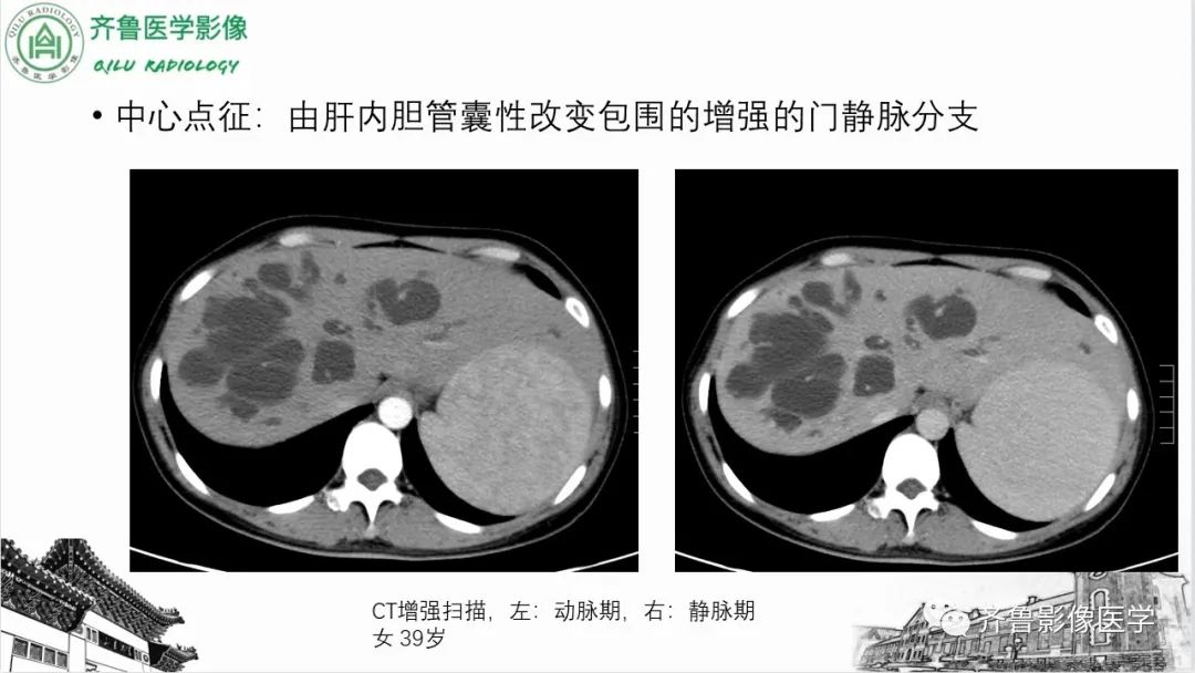 影像PPT - 【PPT】先天性胆管扩张症-23