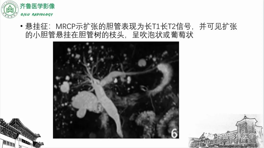 影像PPT - 【PPT】先天性胆管扩张症-25