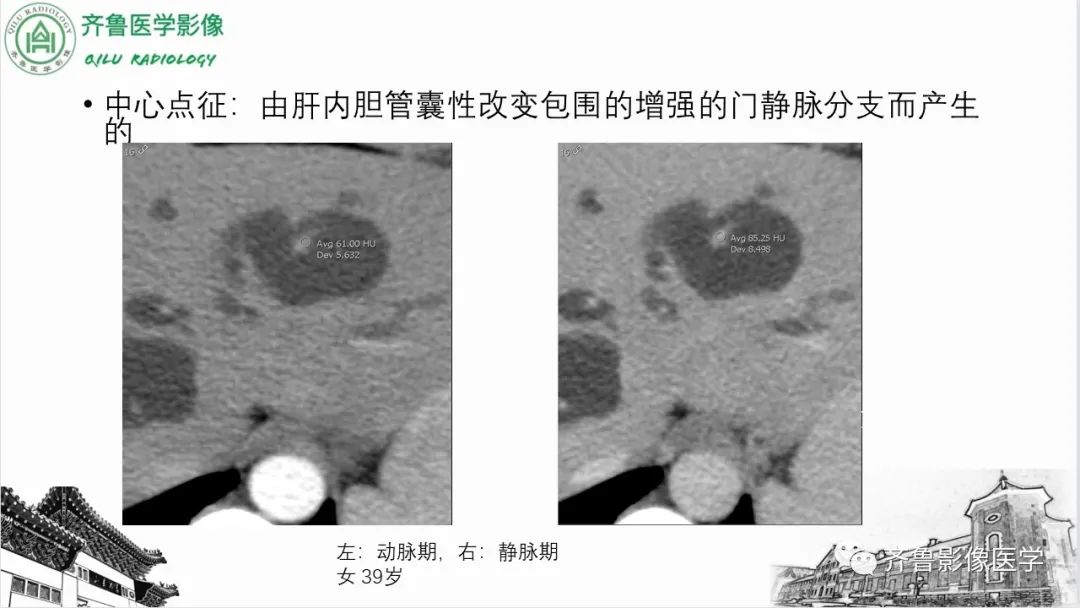 影像PPT - 【PPT】先天性胆管扩张症-24