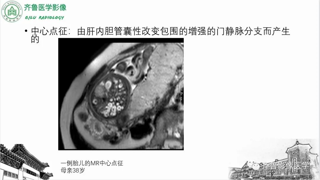影像PPT - 【PPT】先天性胆管扩张症-26