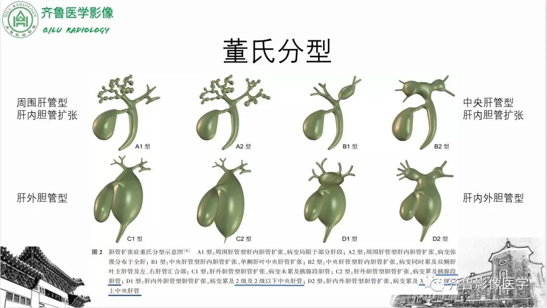 影像PPT - 【PPT】先天性胆管扩张症-29