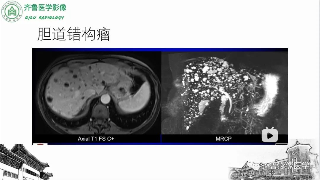影像PPT - 【PPT】先天性胆管扩张症-34