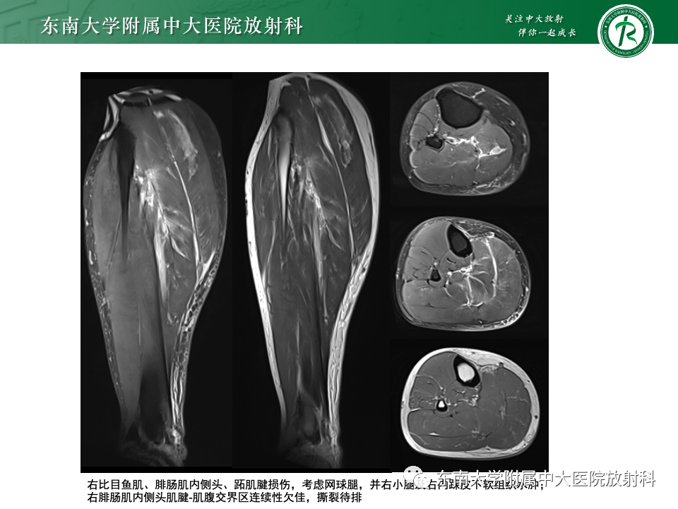 影像PPT - 【PPT】网球腿-3