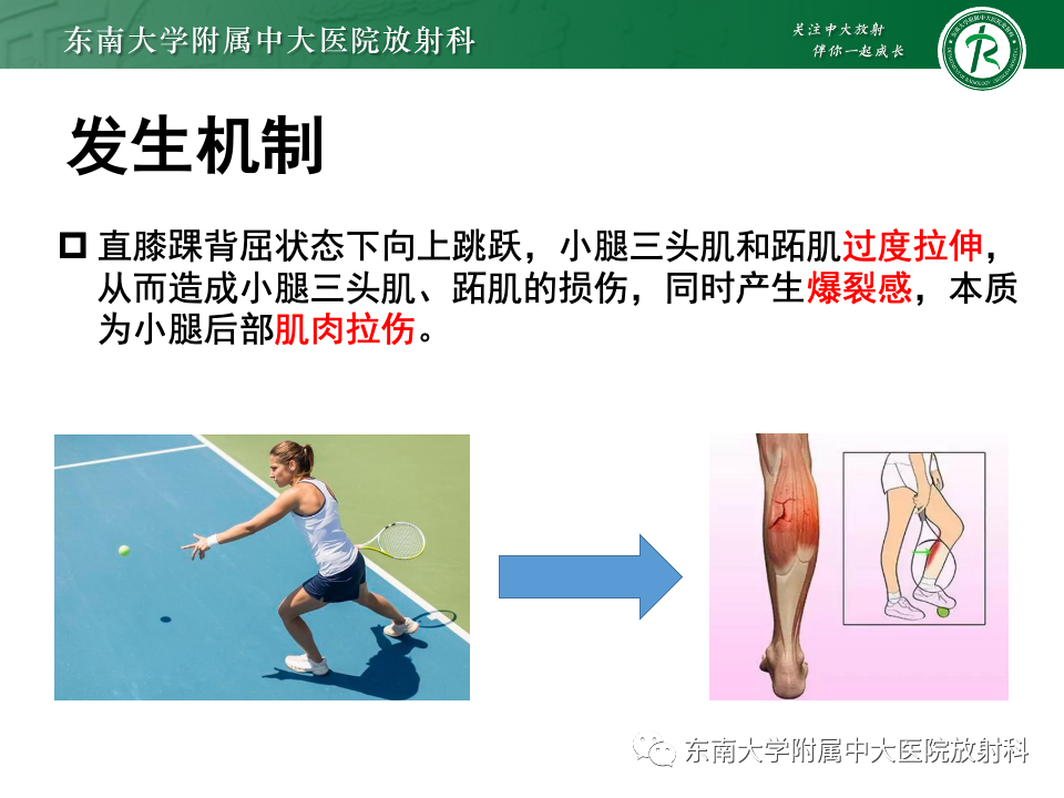 影像PPT - 【PPT】网球腿-11