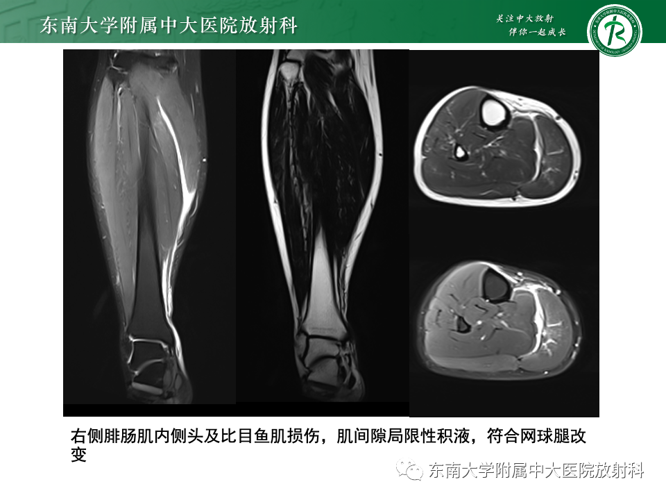 影像PPT - 【PPT】网球腿-22
