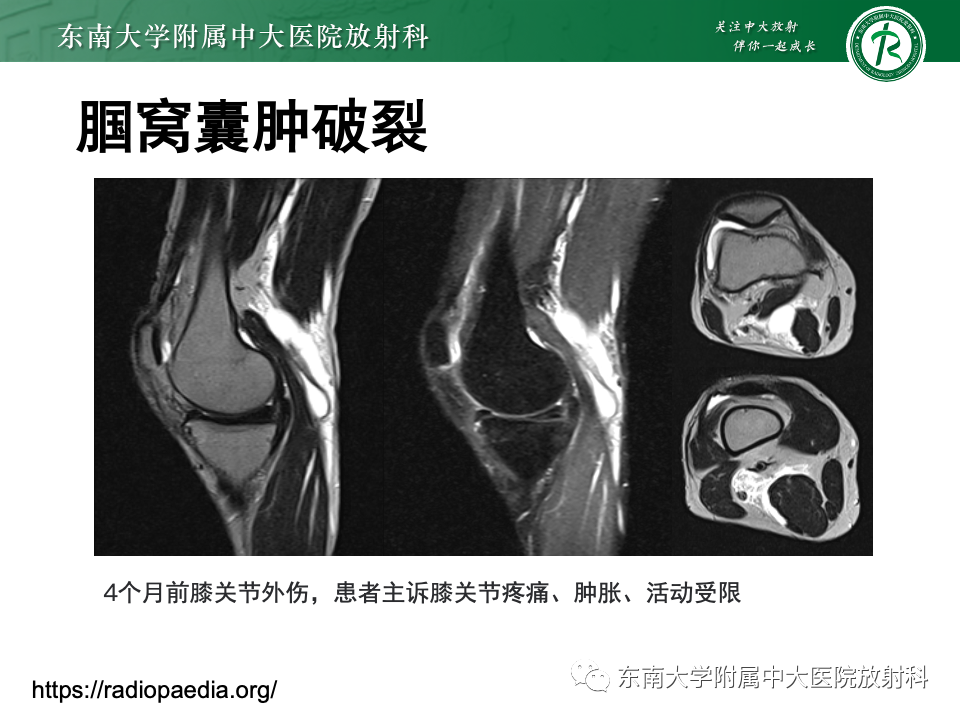 影像PPT - 【PPT】网球腿-29