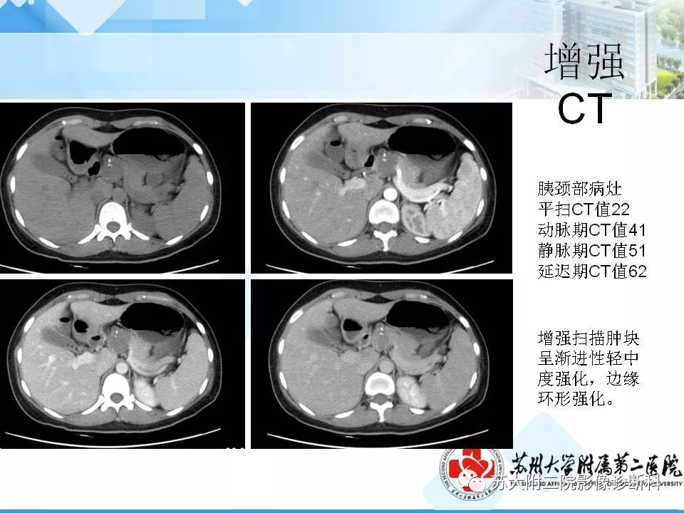 影像PPT - 【病例】胰腺囊性病变3例影像诊断-7