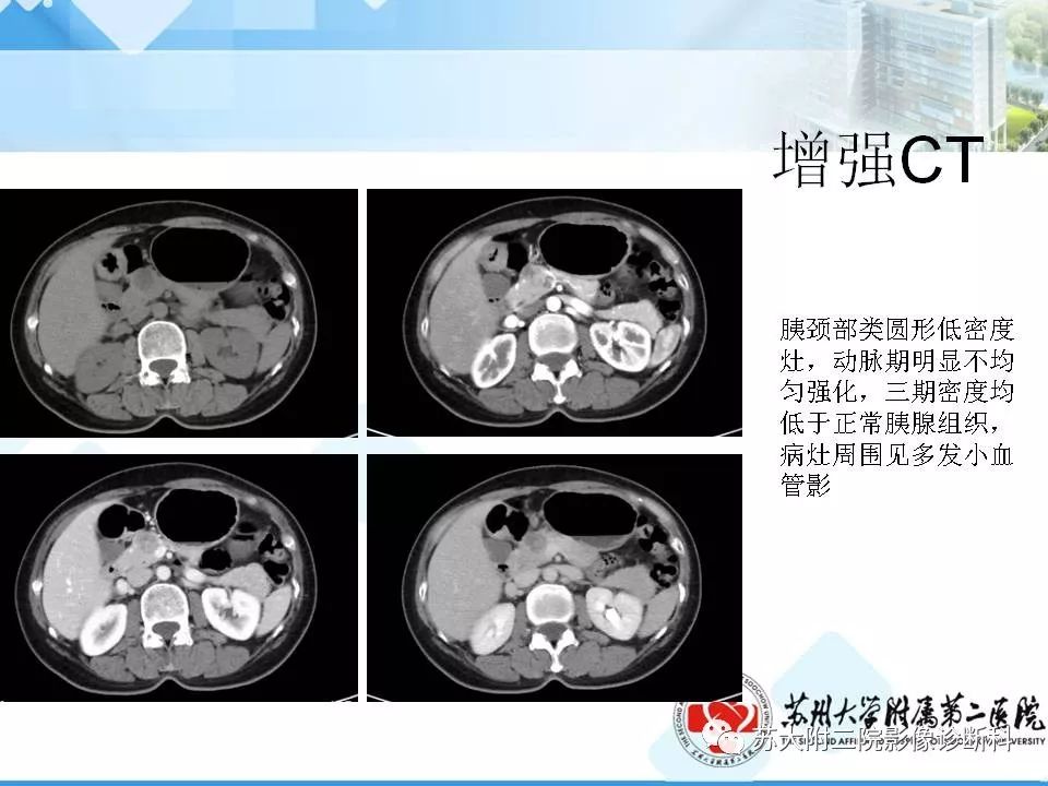 影像PPT - 【病例】胰腺囊性病变3例影像诊断-18