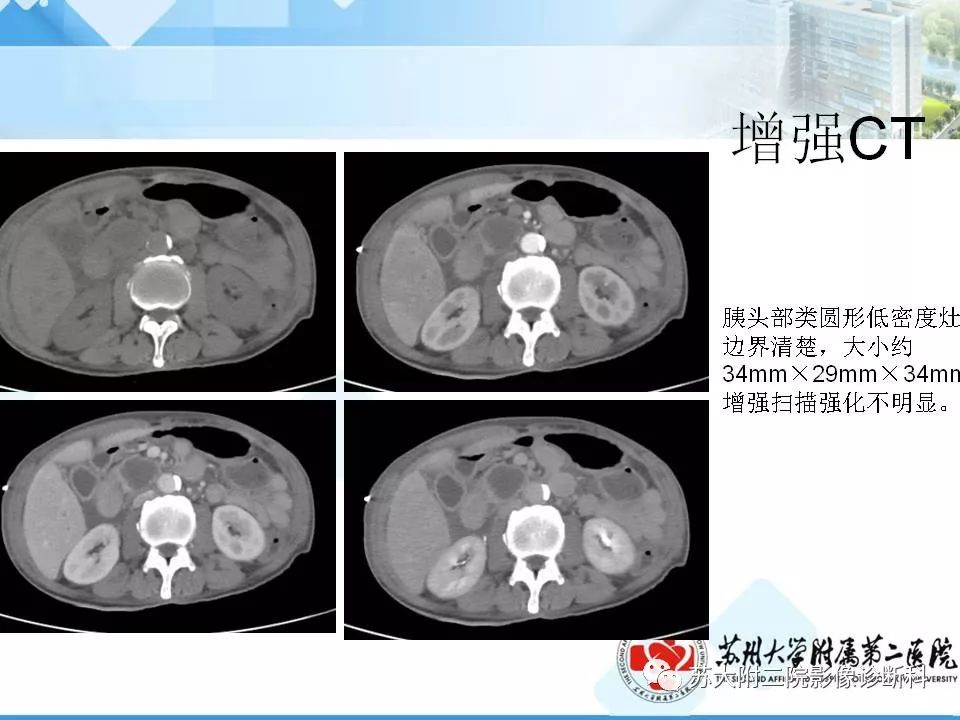 影像PPT - 【病例】胰腺囊性病变3例影像诊断-28