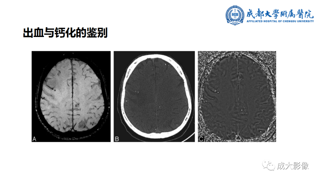 影像PPT - 【PPT】SWI在中枢神经系统疾病中的应用-6