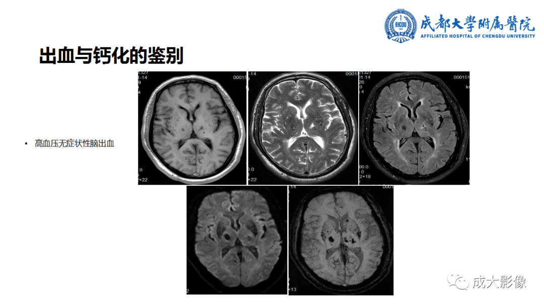 影像PPT - 【PPT】SWI在中枢神经系统疾病中的应用-7