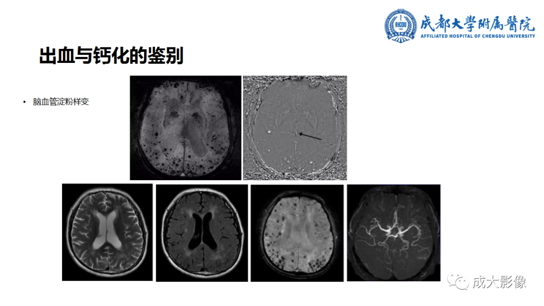 影像PPT - 【PPT】SWI在中枢神经系统疾病中的应用-8