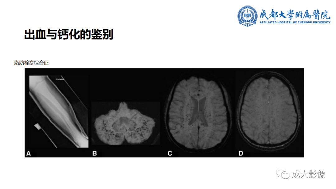 影像PPT - 【PPT】SWI在中枢神经系统疾病中的应用-9