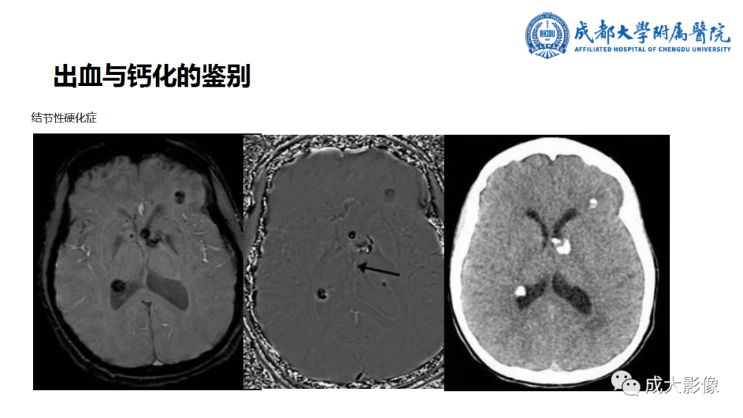 影像PPT - 【PPT】SWI在中枢神经系统疾病中的应用-10