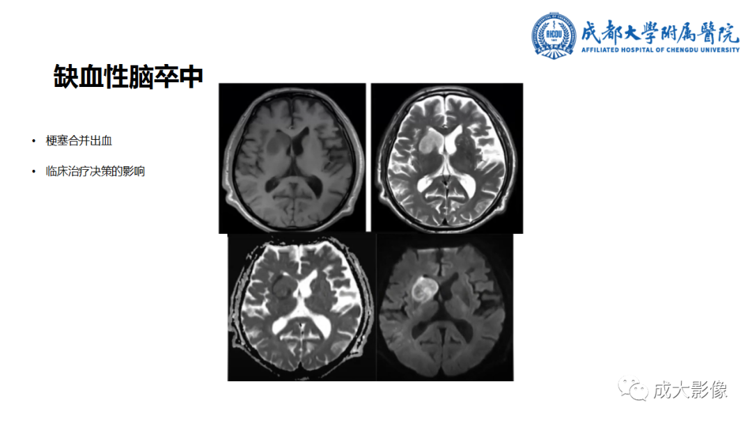 影像PPT - 【PPT】SWI在中枢神经系统疾病中的应用-31