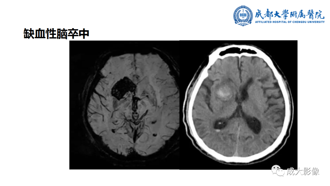 影像PPT - 【PPT】SWI在中枢神经系统疾病中的应用-32