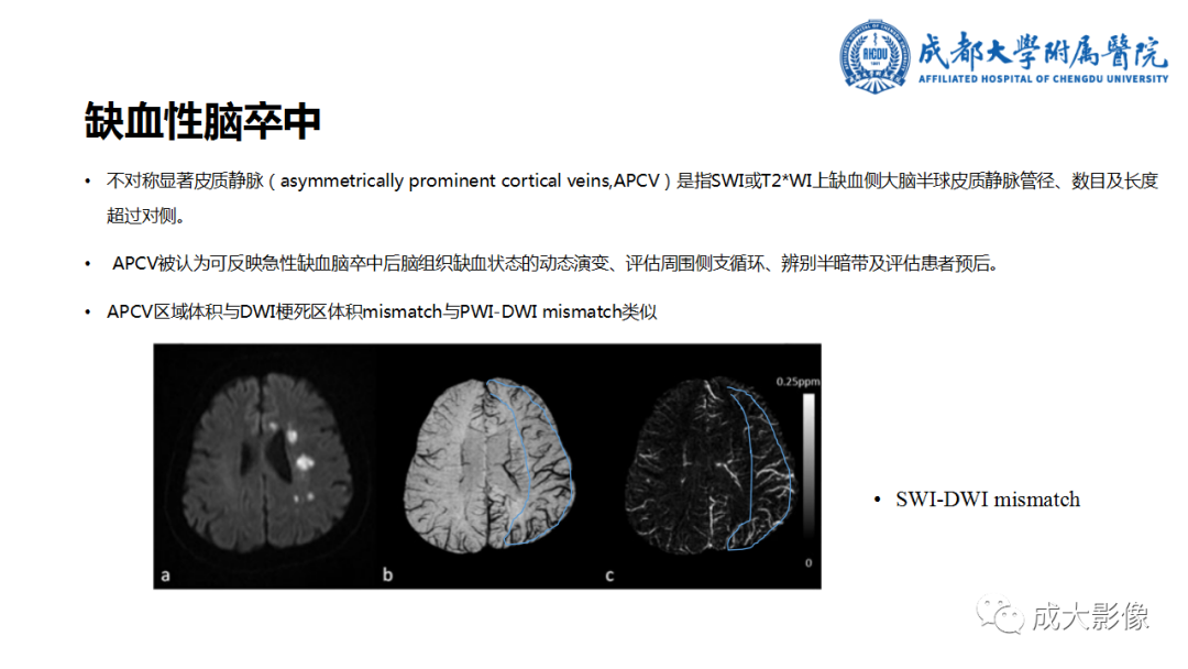 影像PPT - 【PPT】SWI在中枢神经系统疾病中的应用-33