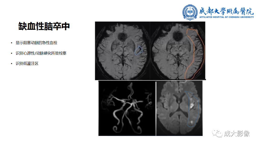 影像PPT - 【PPT】SWI在中枢神经系统疾病中的应用-34