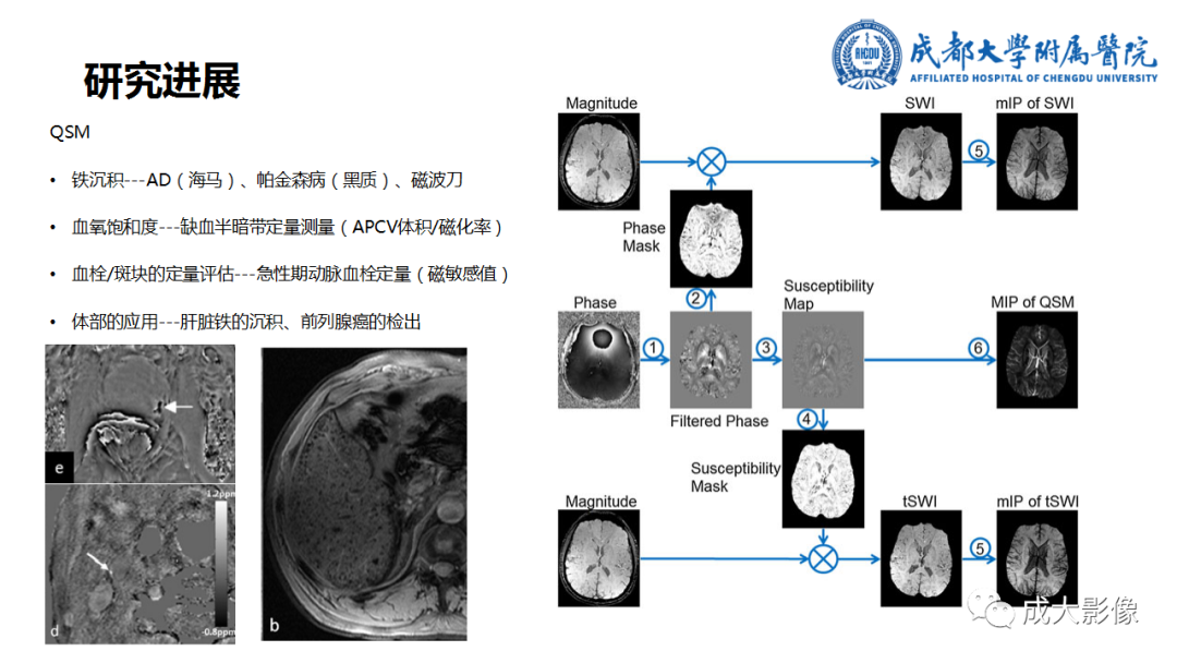 影像PPT - 【PPT】SWI在中枢神经系统疾病中的应用-39