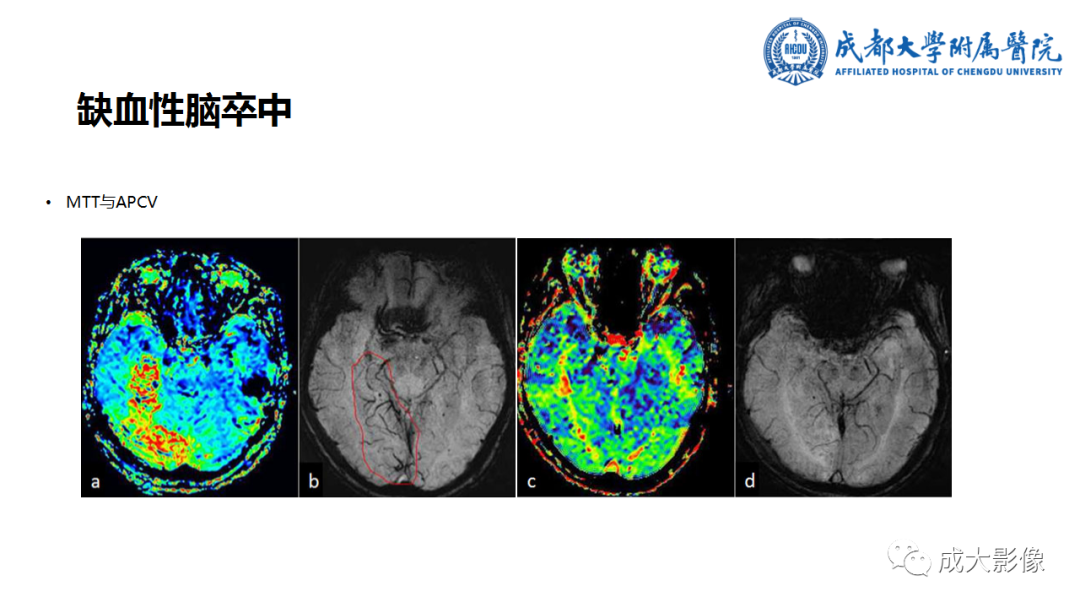 影像PPT - 【PPT】SWI在中枢神经系统疾病中的应用-38
