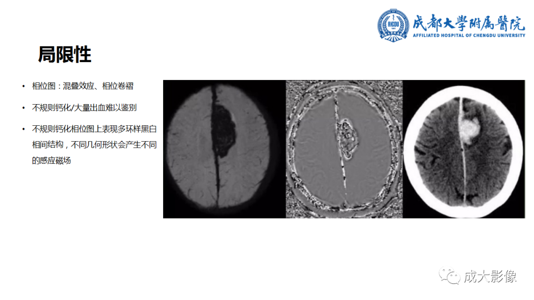 影像PPT - 【PPT】SWI在中枢神经系统疾病中的应用-40
