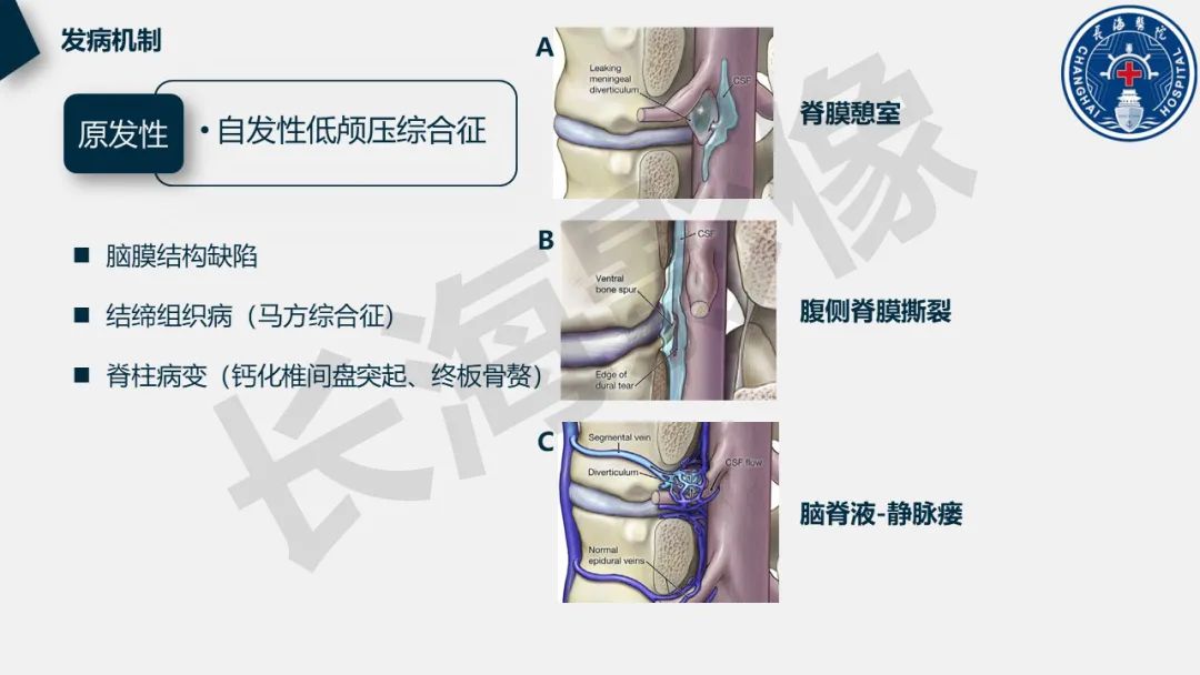 影像PPT - 【PPT】低颅压综合征-11