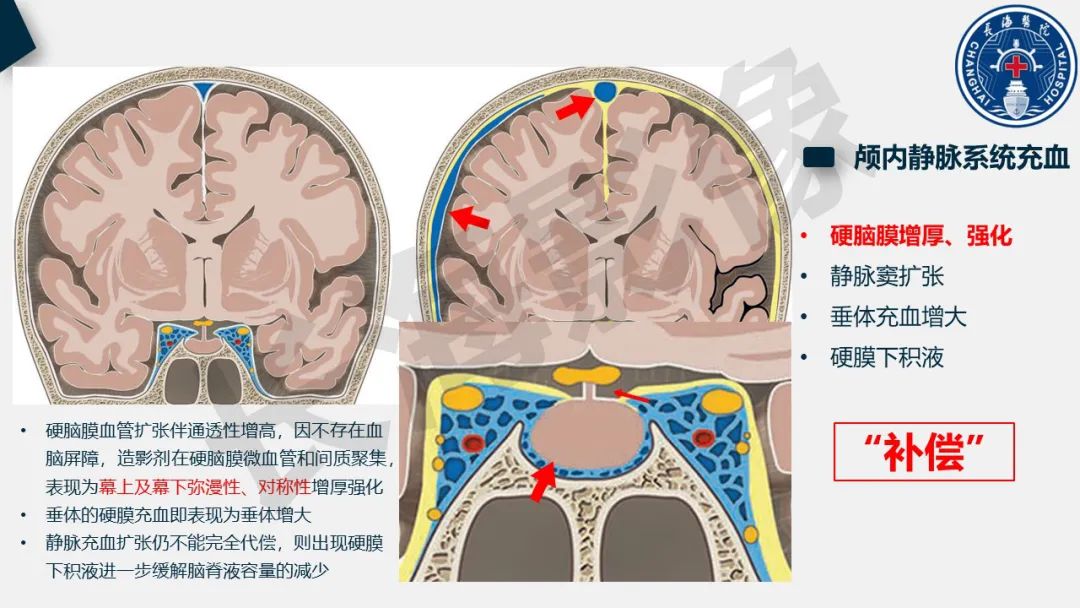 影像PPT - 【PPT】低颅压综合征-17