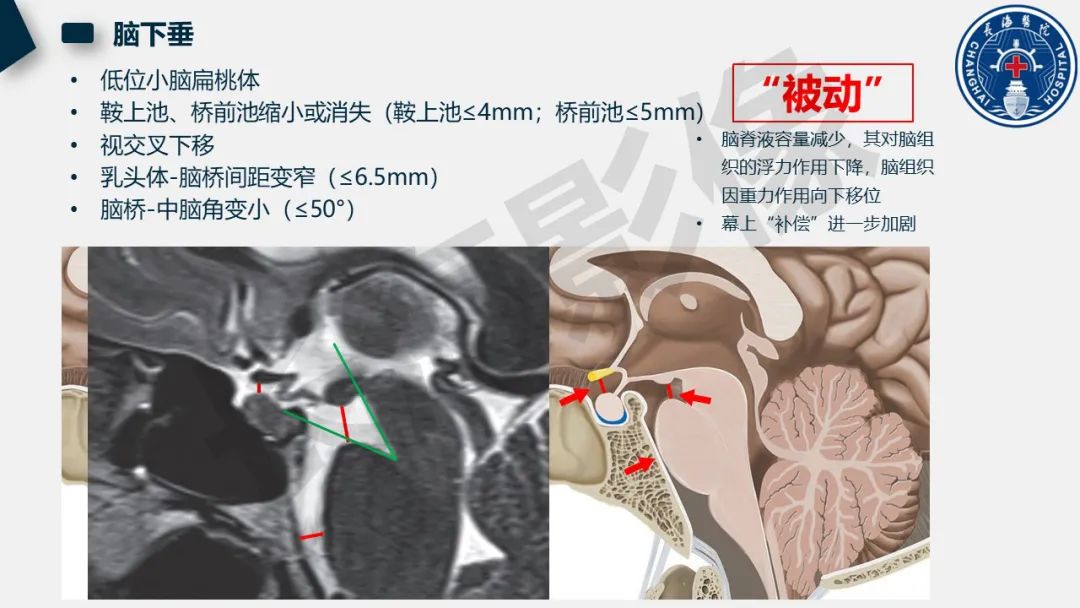 影像PPT - 【PPT】低颅压综合征-20