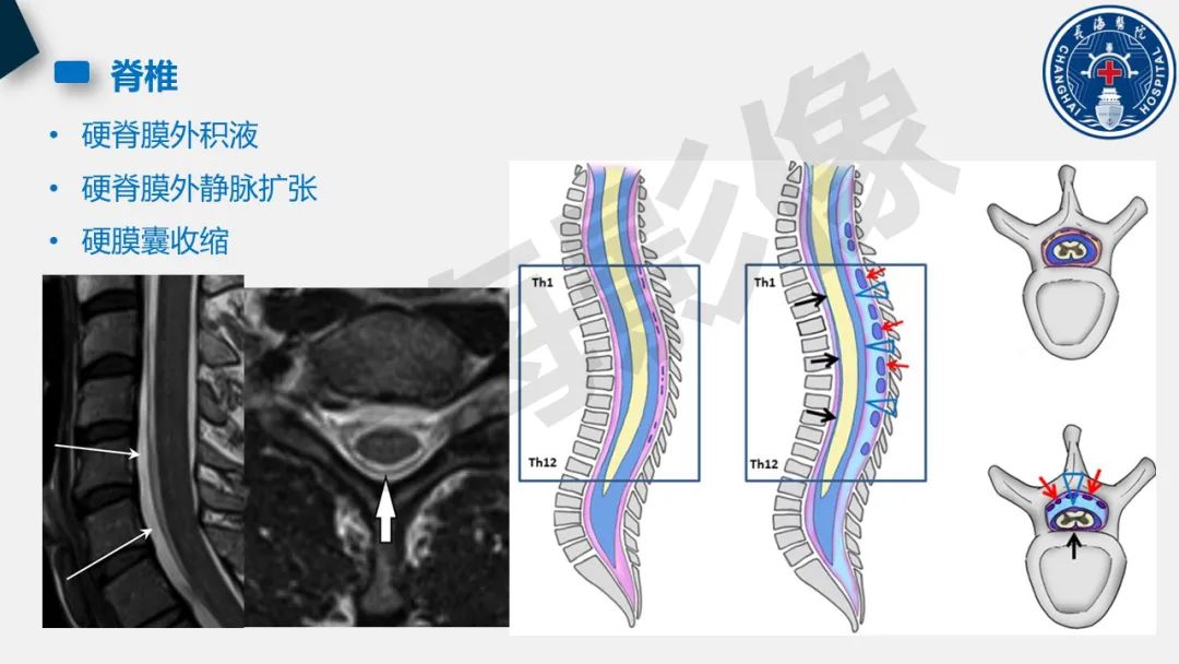 影像PPT - 【PPT】低颅压综合征-24