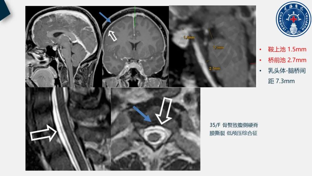 影像PPT - 【PPT】低颅压综合征-26