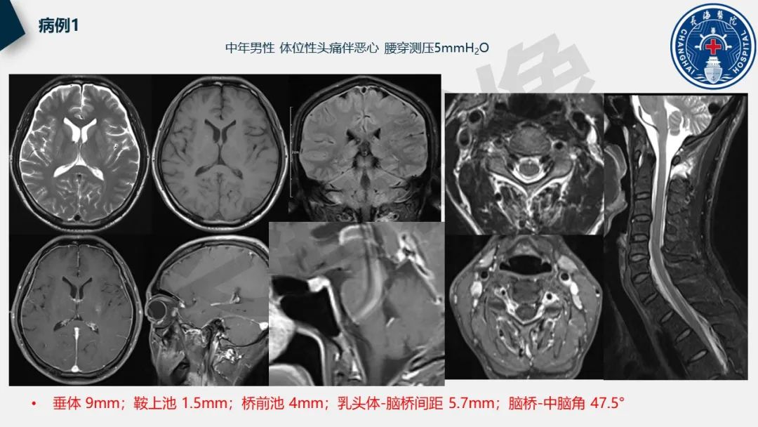 影像PPT - 【PPT】低颅压综合征-27
