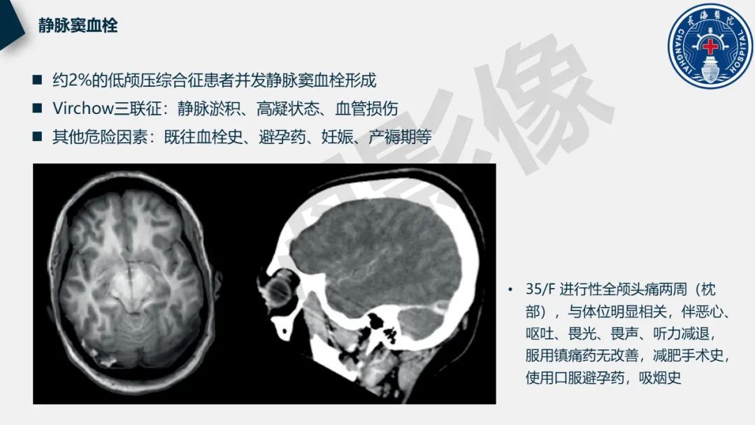 影像PPT - 【PPT】低颅压综合征-32