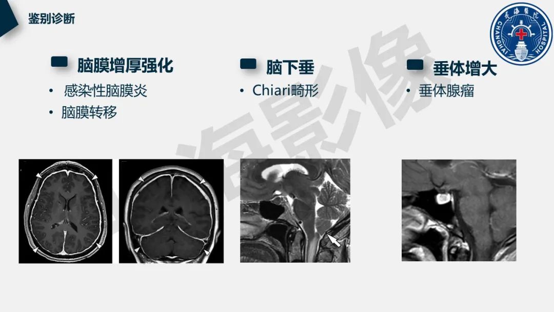 影像PPT - 【PPT】低颅压综合征-34