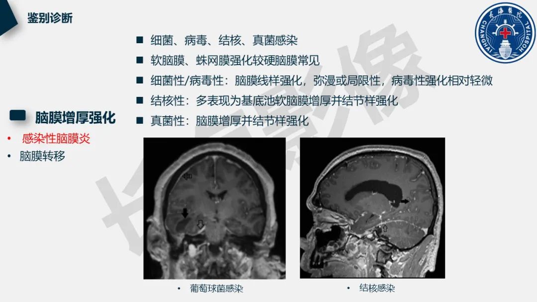 影像PPT - 【PPT】低颅压综合征-35
