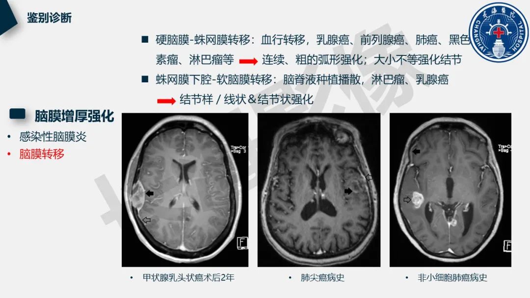 影像PPT - 【PPT】低颅压综合征-36