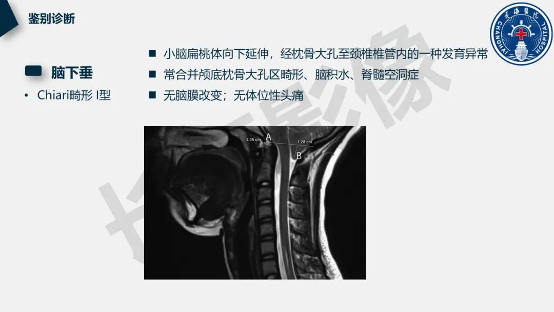 影像PPT - 【PPT】低颅压综合征-37