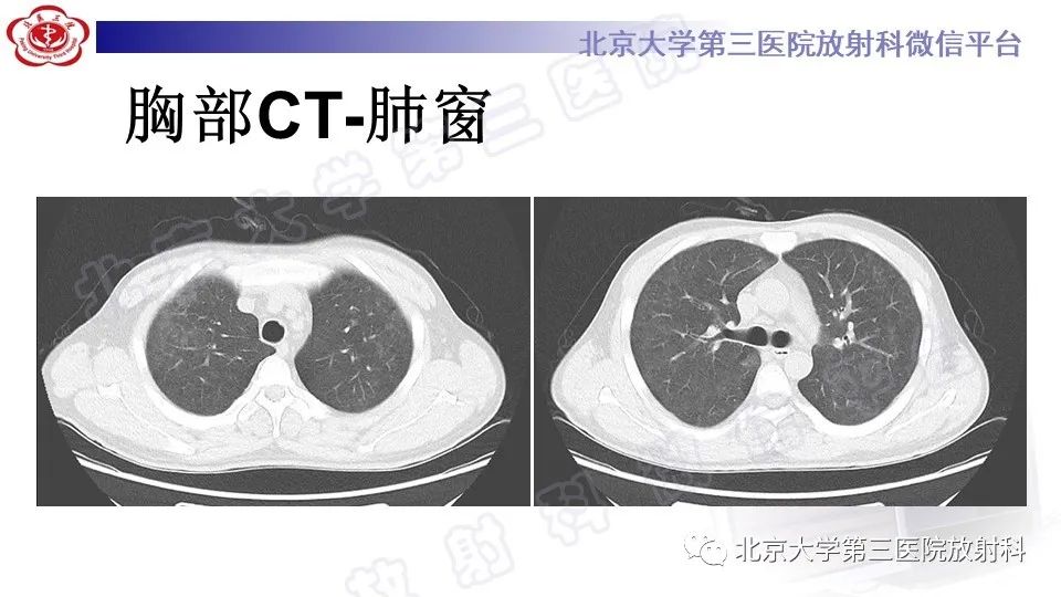 影像PPT - 【PPT】病毒性肺炎-3