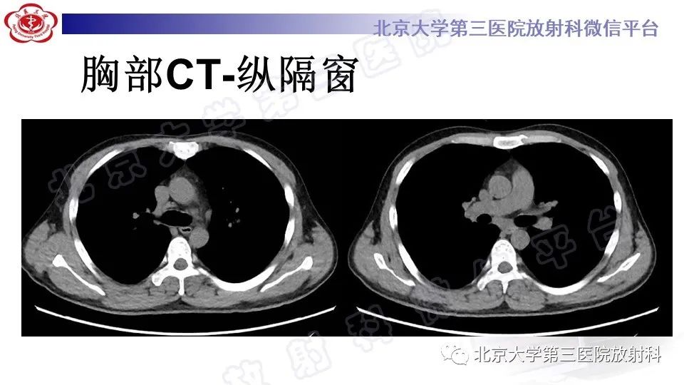 影像PPT - 【PPT】病毒性肺炎-5