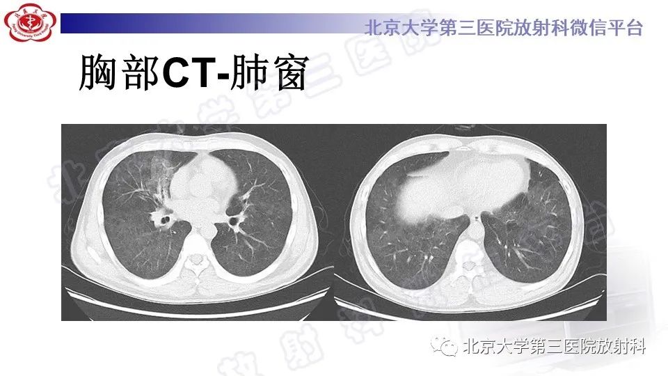 影像PPT - 【PPT】病毒性肺炎-4
