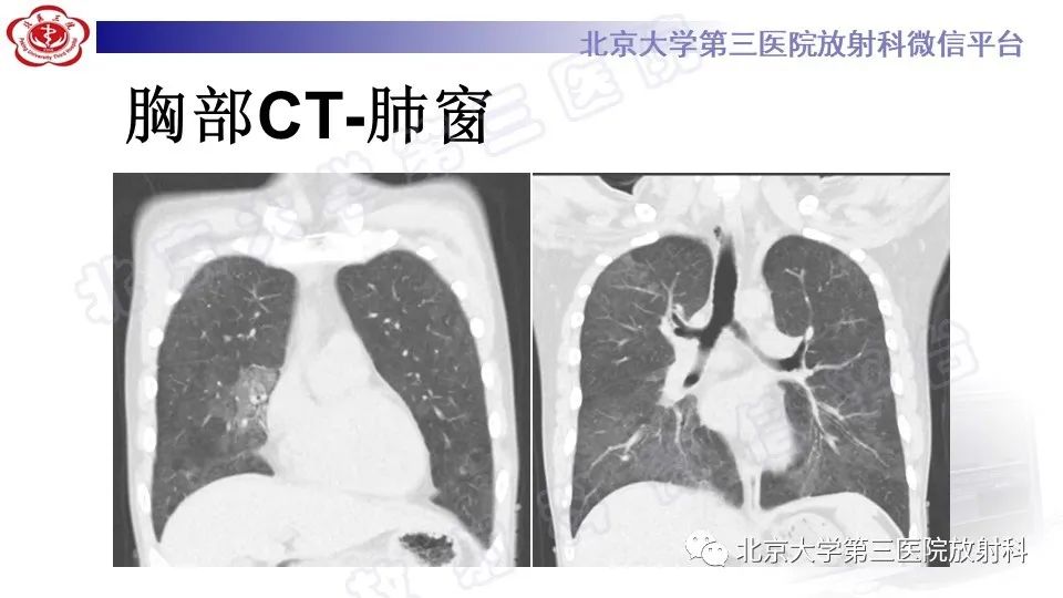 影像PPT - 【PPT】病毒性肺炎-6