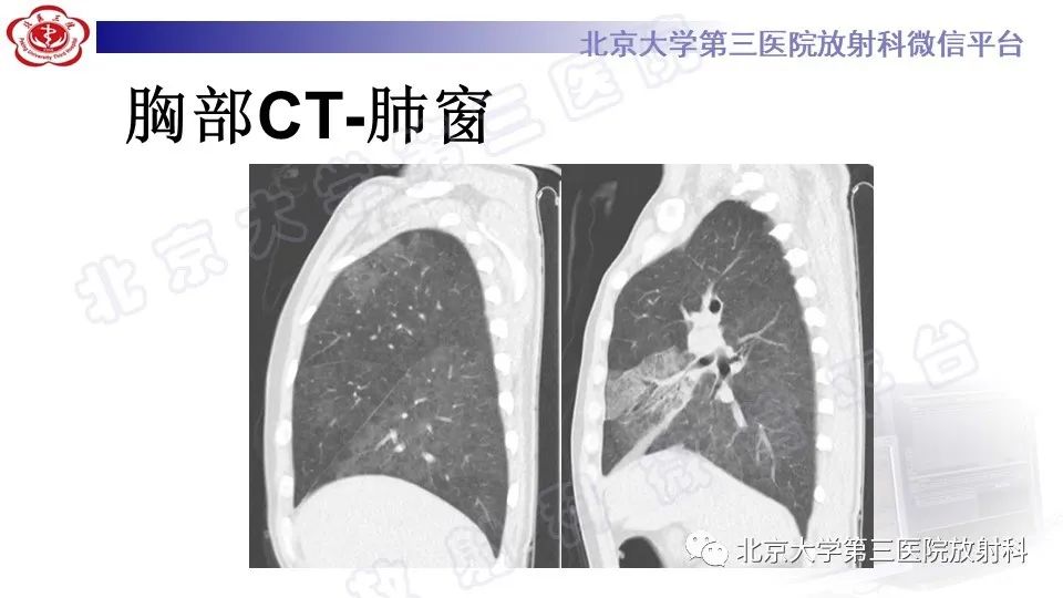 影像PPT - 【PPT】病毒性肺炎-7